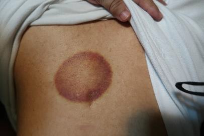 成人感染新冠24