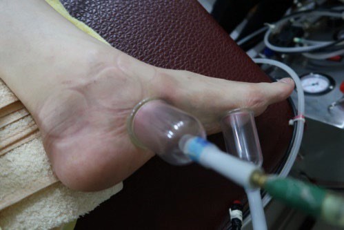 足踝損傷疼痛3-2-3