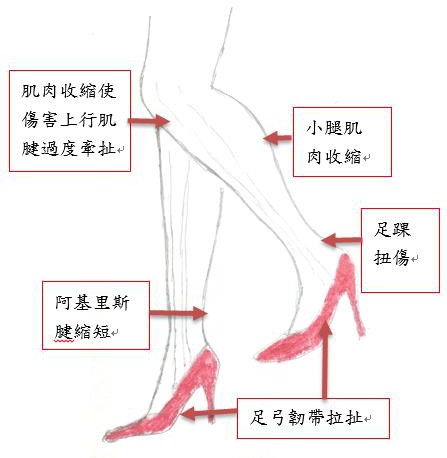 高跟鞋症候群1