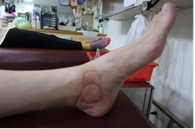 足踝損傷疼痛3-3-1