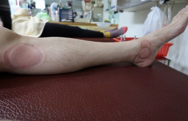 足踝損傷疼痛3-3-2