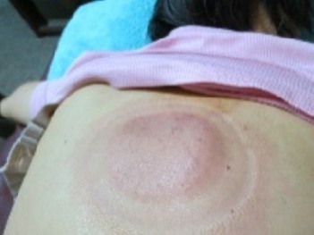 拔罐後印記的判讀1