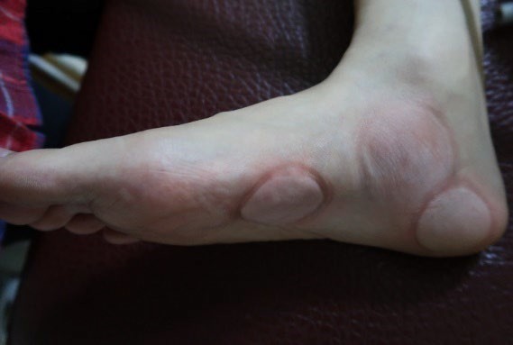 足踝損傷疼痛3-4-1