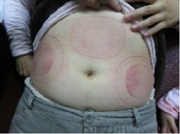 拔罐後印記的判讀2