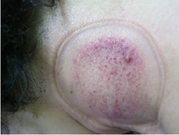 拔罐後印記的判讀4