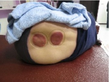 拔罐後印記的判讀3