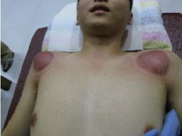 拔罐後印記的判讀5