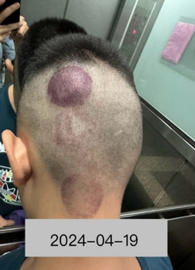 小朋友頭部創傷1