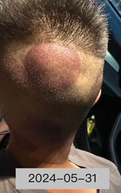 小朋友頭部創傷2