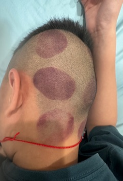 小朋友頭部創傷4