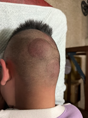 小朋友頭部創傷5