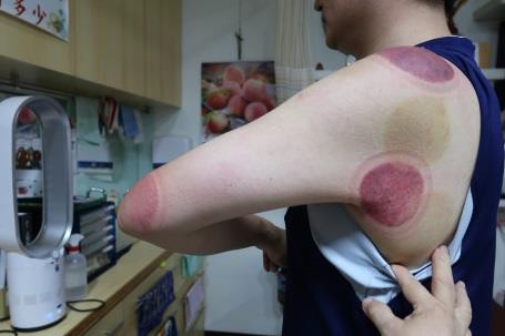 肩臂上肢疼痛II-1