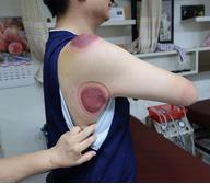 肩臂上肢疼痛II-2