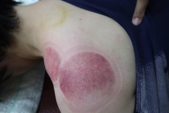 肩臂上肢疼痛圖V