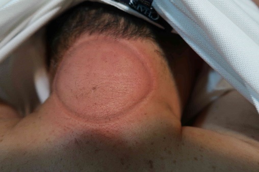 無症狀長新冠病患1