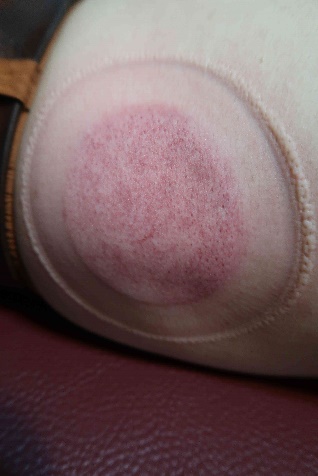 無症狀長新冠病患2