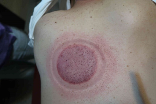 無症狀長新冠病患4