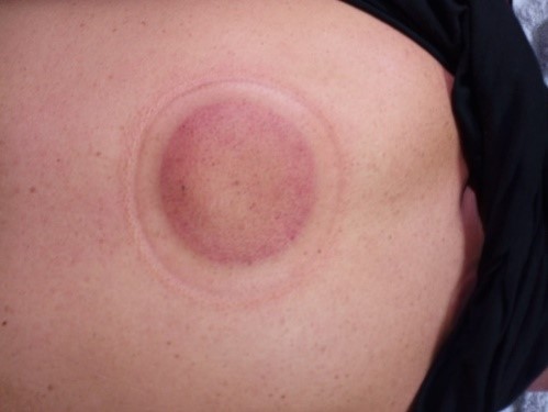 無症狀長新冠病患6