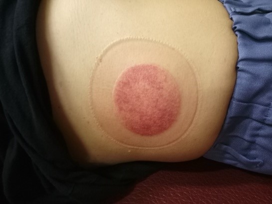 無症狀長新冠病患8