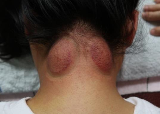 頸部及肩臂脹痛圖I-1