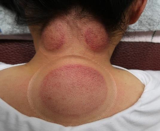 頸部及肩臂脹痛圖I-2