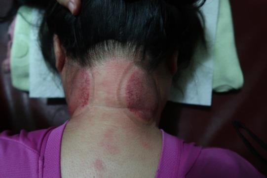 頸部及肩臂脹痛圖II-1