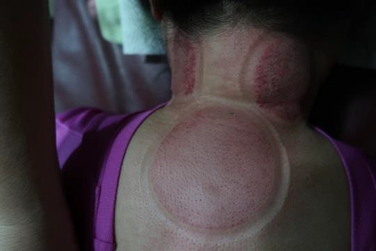 頸部及肩臂脹痛圖II-2