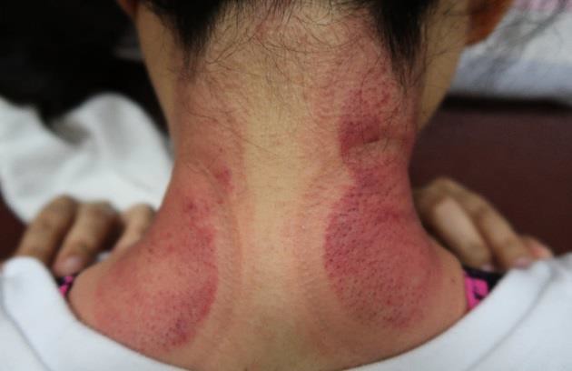 頸部及肩臂脹痛圖III