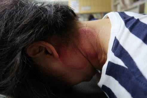 頸部及肩臂脹痛圖V-1