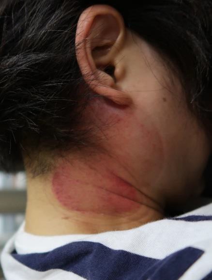 頸部及肩臂脹痛圖V-2