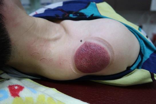 頸部及肩臂脹痛圖VI-1