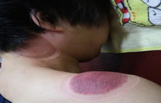 頸部及肩臂脹痛圖VI-2