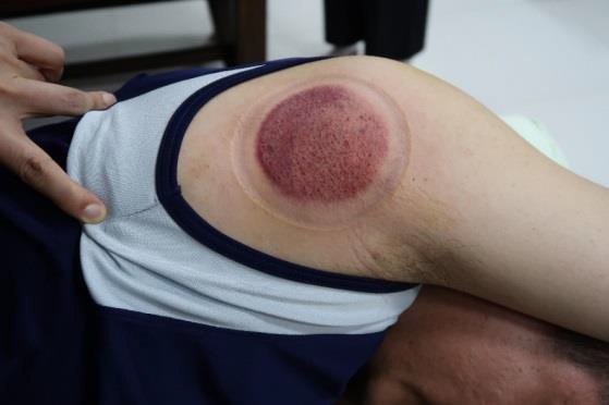 頸部及肩臂脹痛圖VII-1