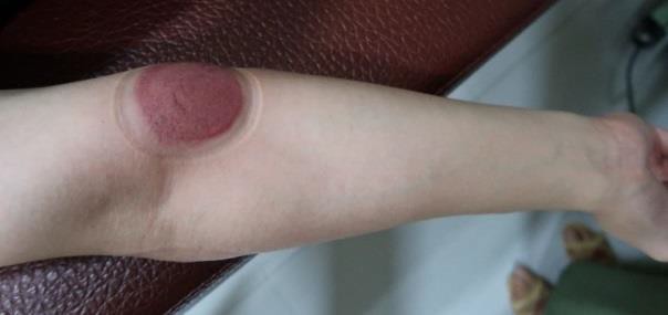 頸部及肩臂脹痛圖VII-2