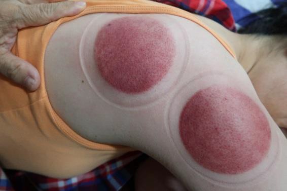 頸部及肩臂脹痛圖VIII-1