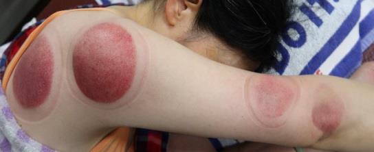 頸部及肩臂脹痛圖VIII-2