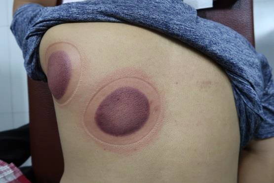 頸部及肩臂脹痛圖X