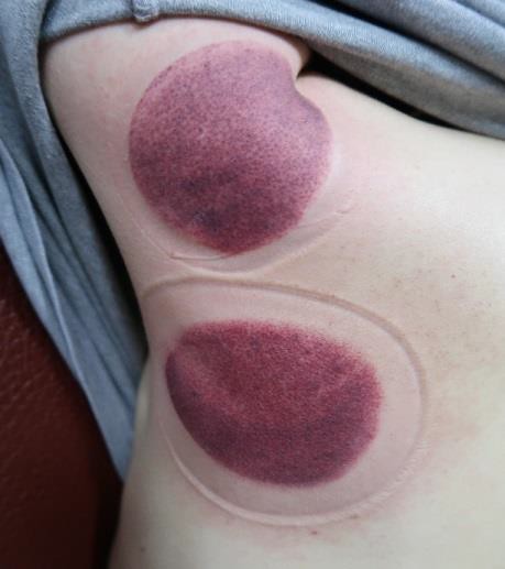 頸部及肩臂脹痛圖X-1