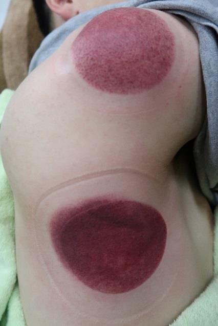 頸部及肩臂脹痛圖 XI-2