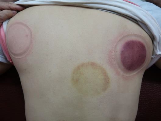 頸部及肩臂脹痛圖XIV