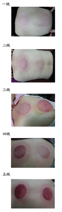 拔罐後印記的顏色級數