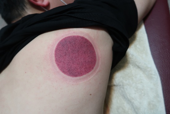 「拔罐後印記」16