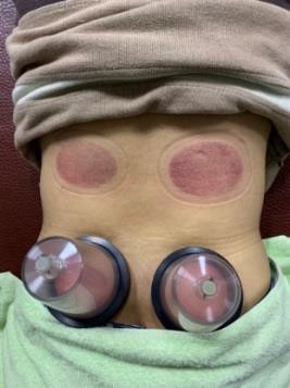 下背痛實例個案報告1