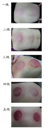 腸道拔罐印記4